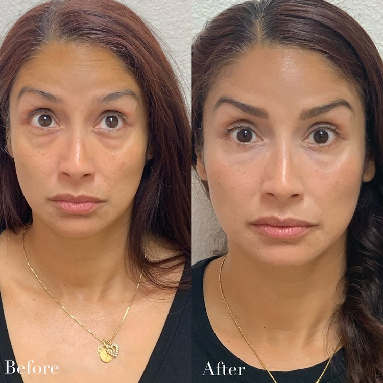 Patient doing botox image