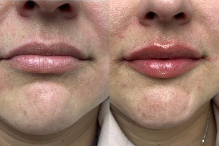 Patient doing botox image