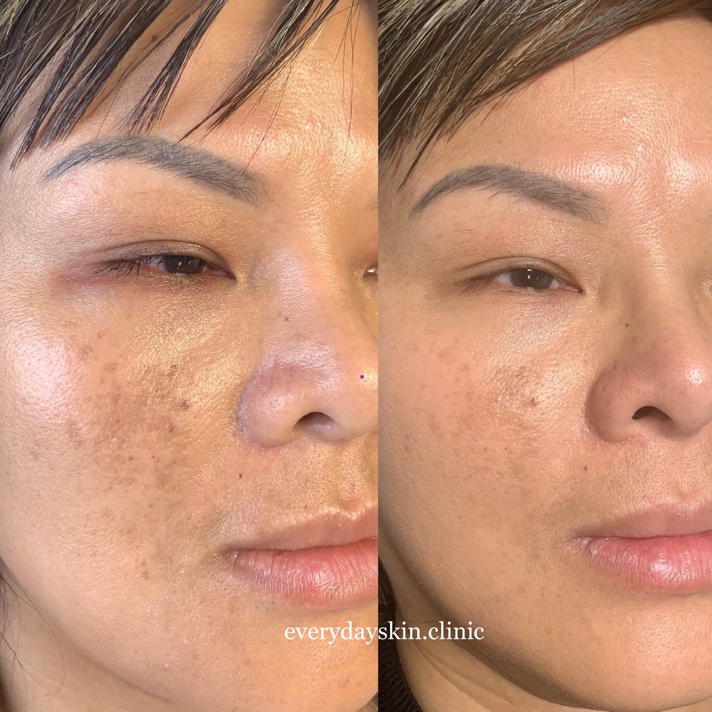 An image of a patient microneedling